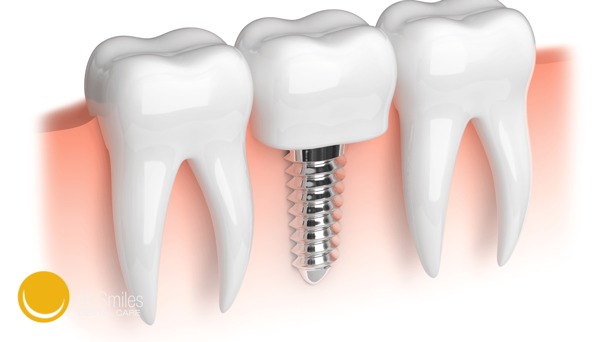 The Role of Bone Density in Successful Dental Implants