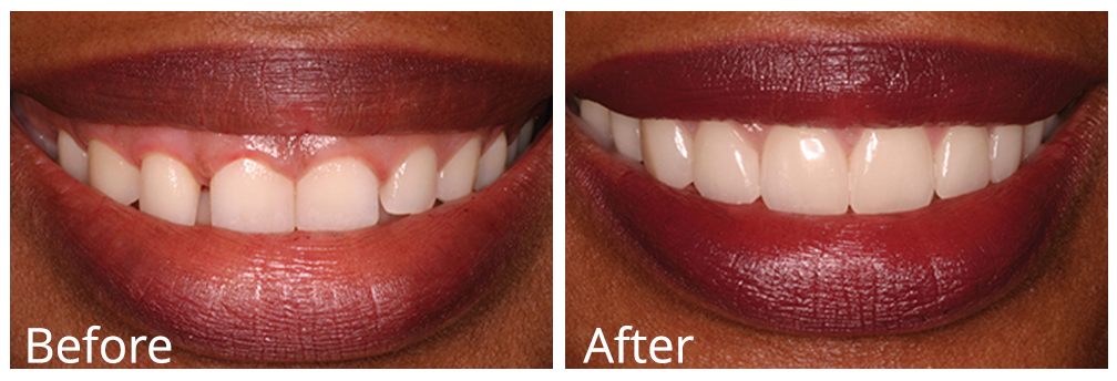 Gum shortening before and after