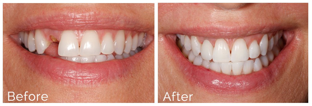 Single tooth implant before and after